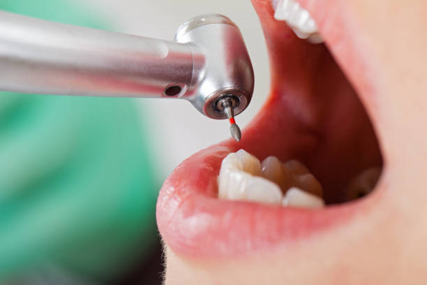 Best Emergency Dental Care for Abscessed Tooth in Badin, NC